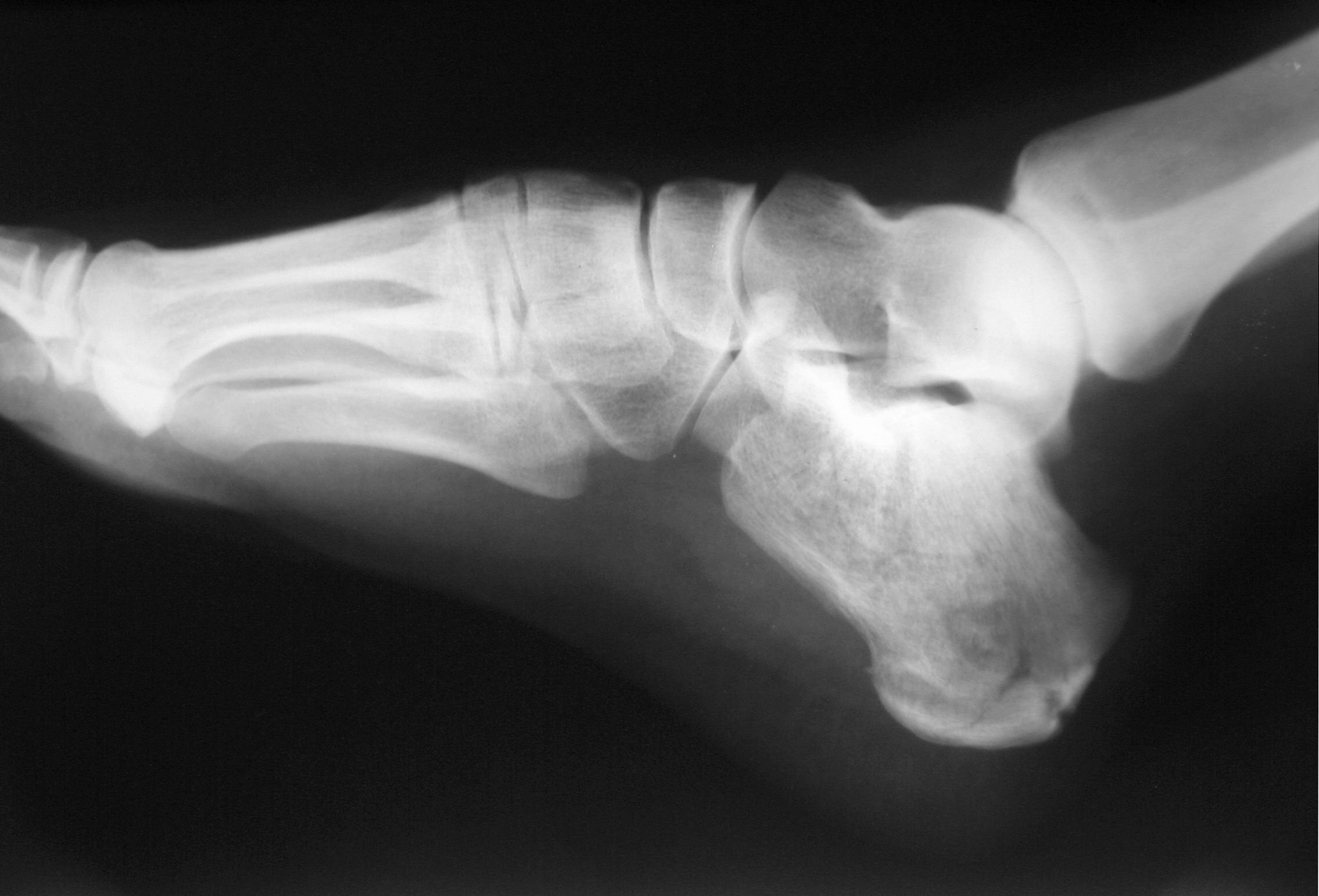 The Impact of Calcaneus Injuries on Mobility and Daily Life - Legal ...