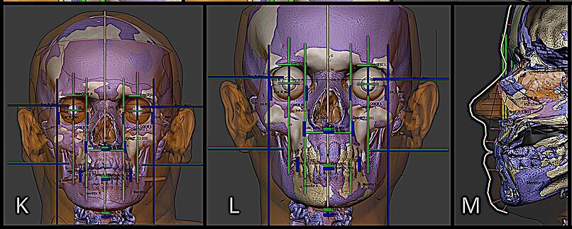 Forensic Reconstruction was Released to Identify Skeletal Remains in Cork.